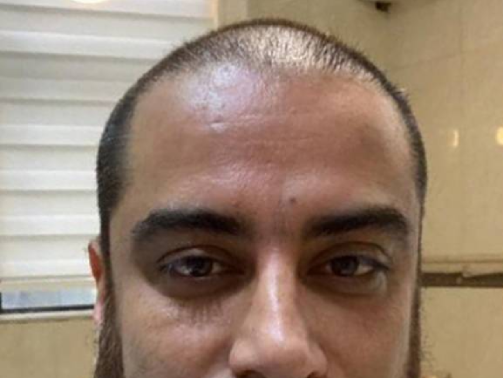 قبل از کاشت مو