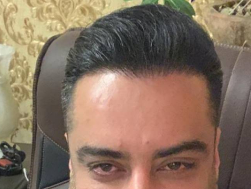 بعد از کاشت مو