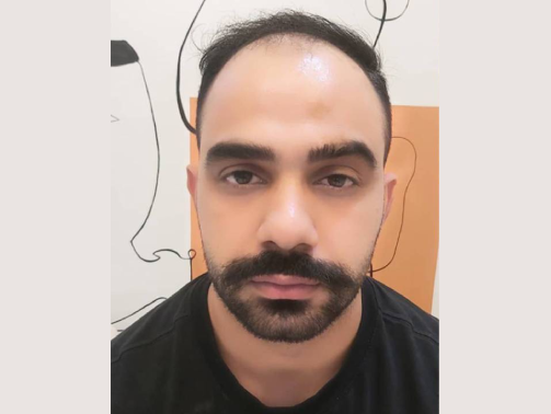 قبل از کاشت مو
