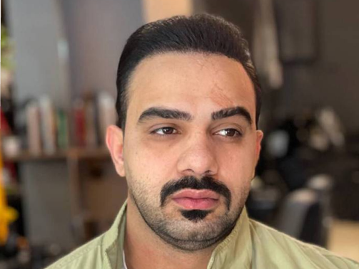 بعد از کاشت مو
