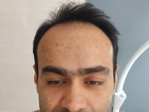 قبل از کاشت مو
