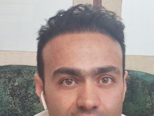 بعد از کاشت مو