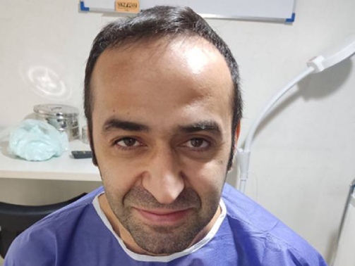 قبل از کاشت مو
