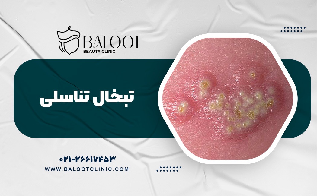 تبخال تناسلی