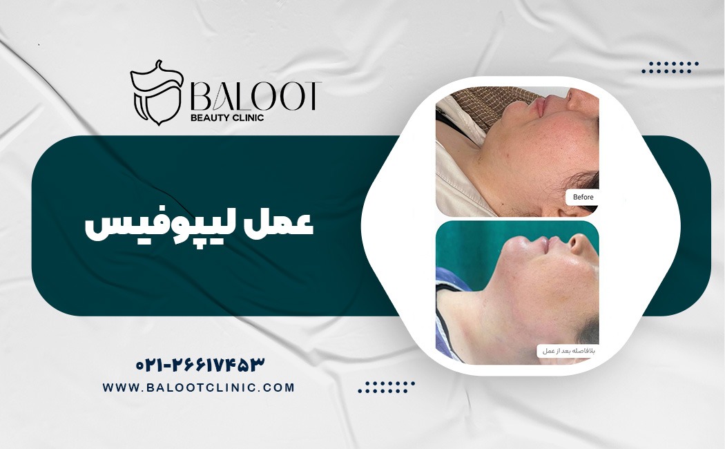 عمل لیپوفیس چیست
