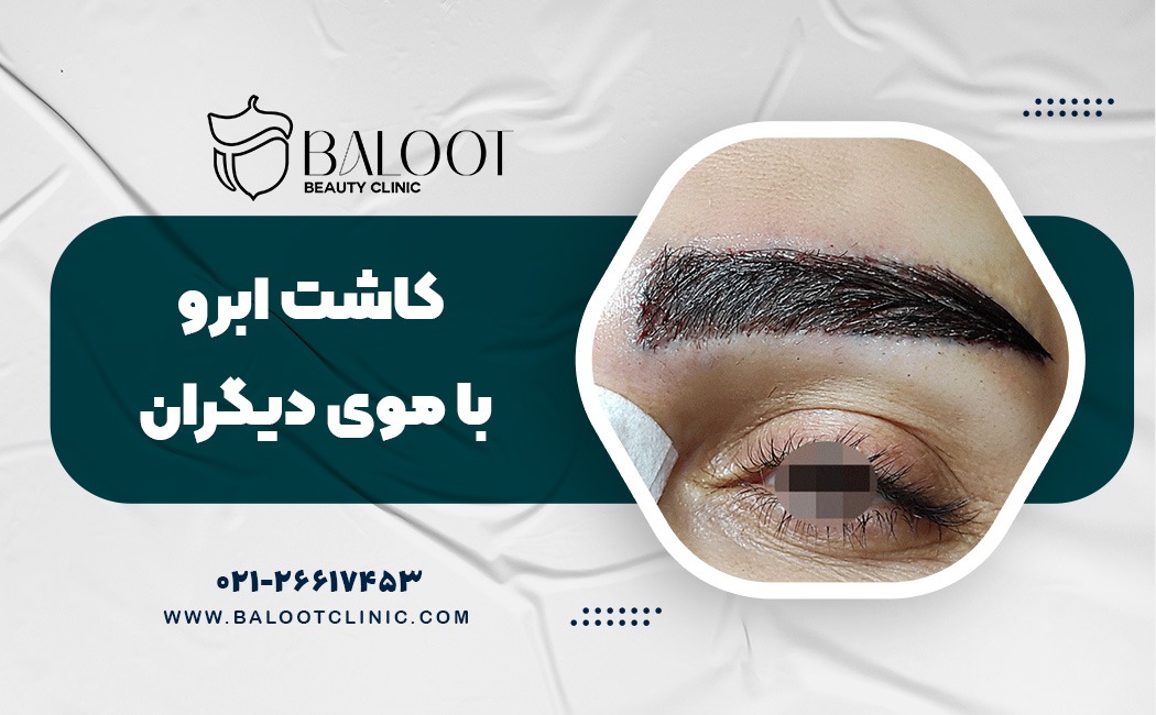 کاشت ابرو با موی دیگران