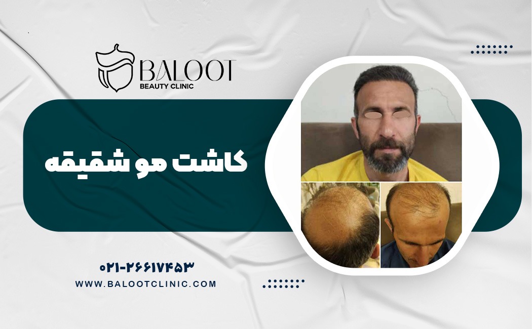 کاشت مو شقیقه