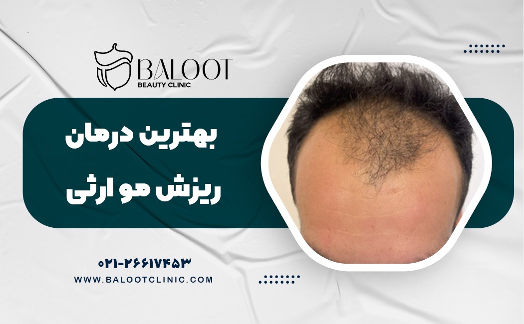 بهترین درمان برای ریزش موی ارثی در مردان قبل از ۳۰ سالگی