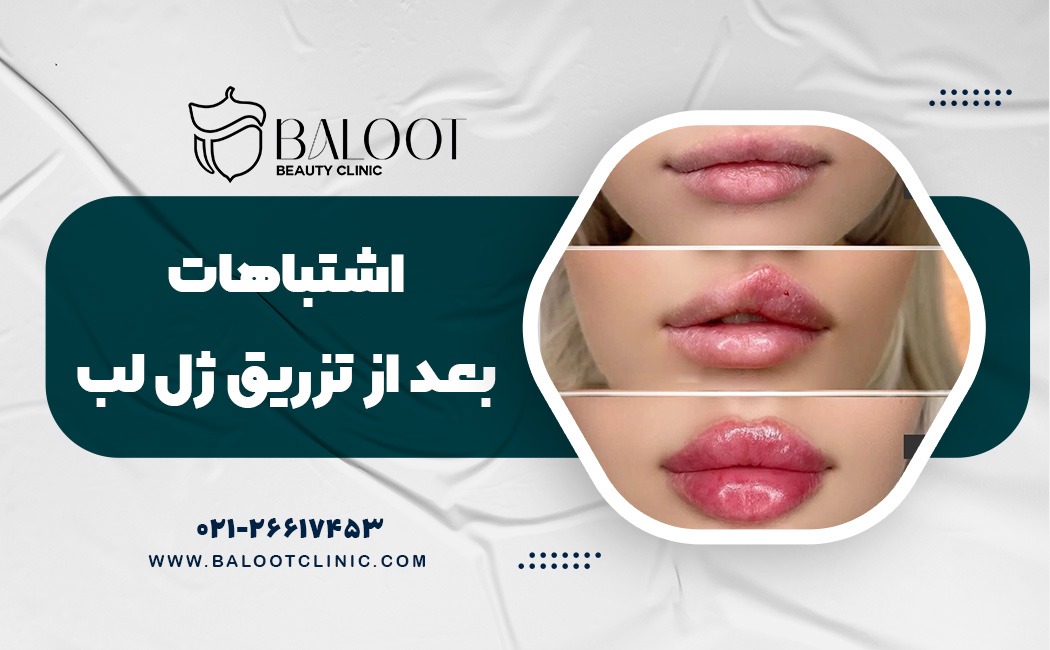 ۷اشتباه بعد از تزریق ژل لب که نتیجه را خراب می‌کند
